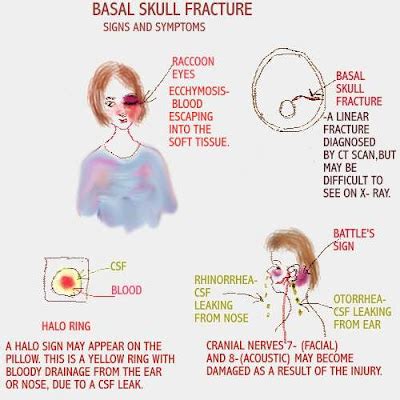 halo sign csf|Basal skull fracture and the halo sign